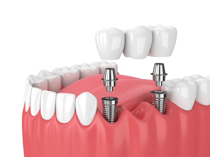 Featured image for Types of Dental Bridges