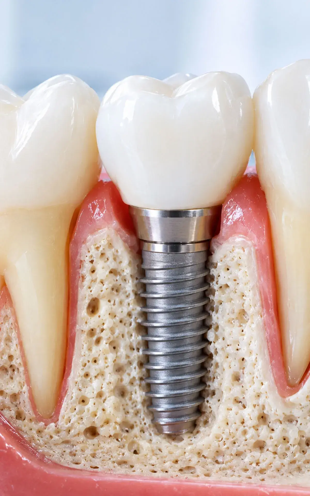 Dental Implants